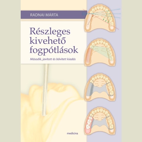 Részleges kivehető fogpótlások 2. kiadás